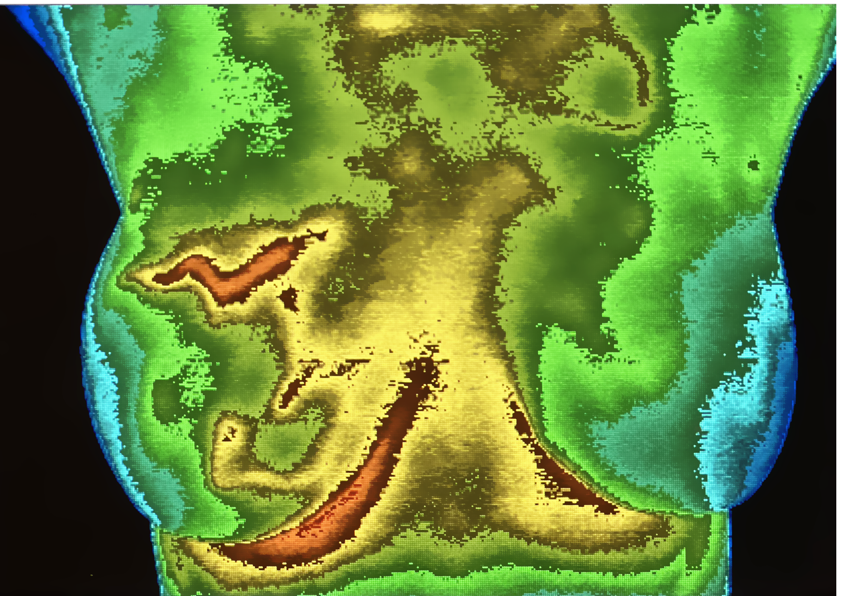 Cancer detected Breast Thermography